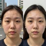 쥐젖 제거 연고 효과적으로 사용하는 방법 쥐젖 제거 연고를 얼굴에 바르는 모습과 사용 전후 피부 변화