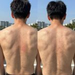 모기 물렸을때 리도맥스 연고와 상처 상태 비교 사진